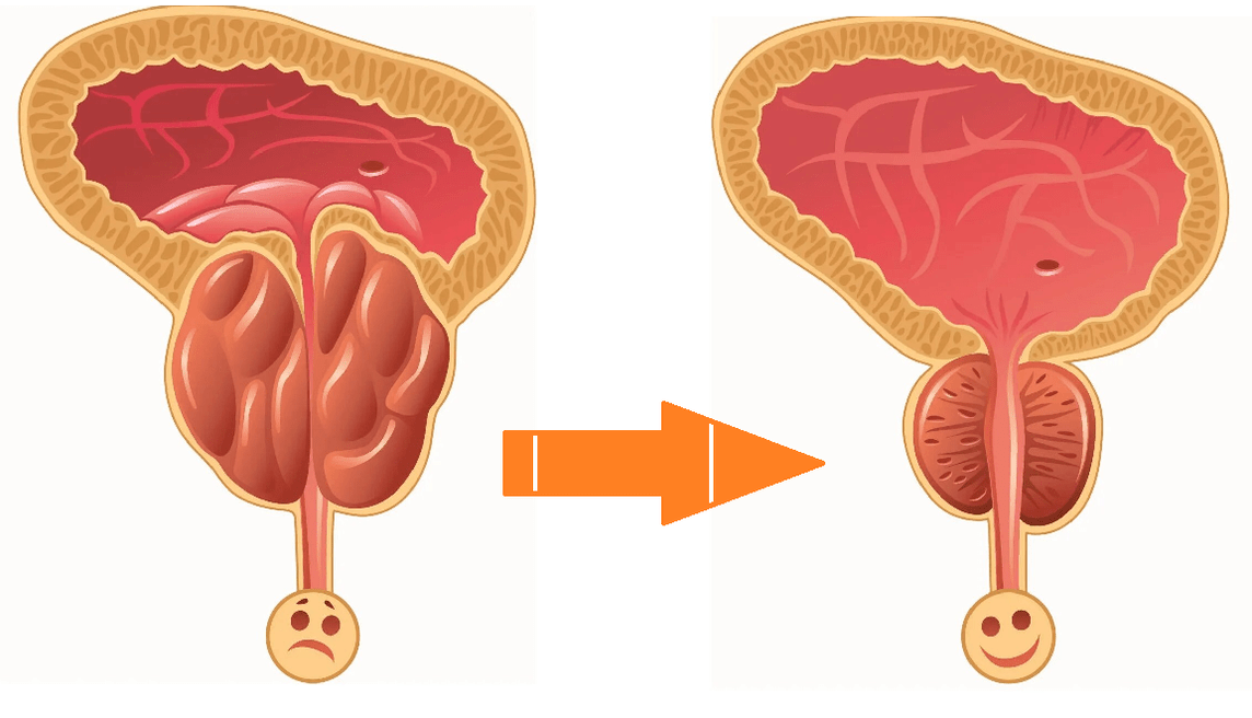 Účinok Uromexil Forte na prostatu s prostatitídou a adenómom